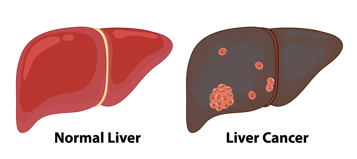 How to Detect Liver Cancer Early? | Liver Surgery India