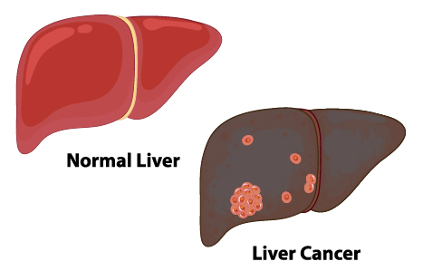 How to Detect Liver Cancer Early?