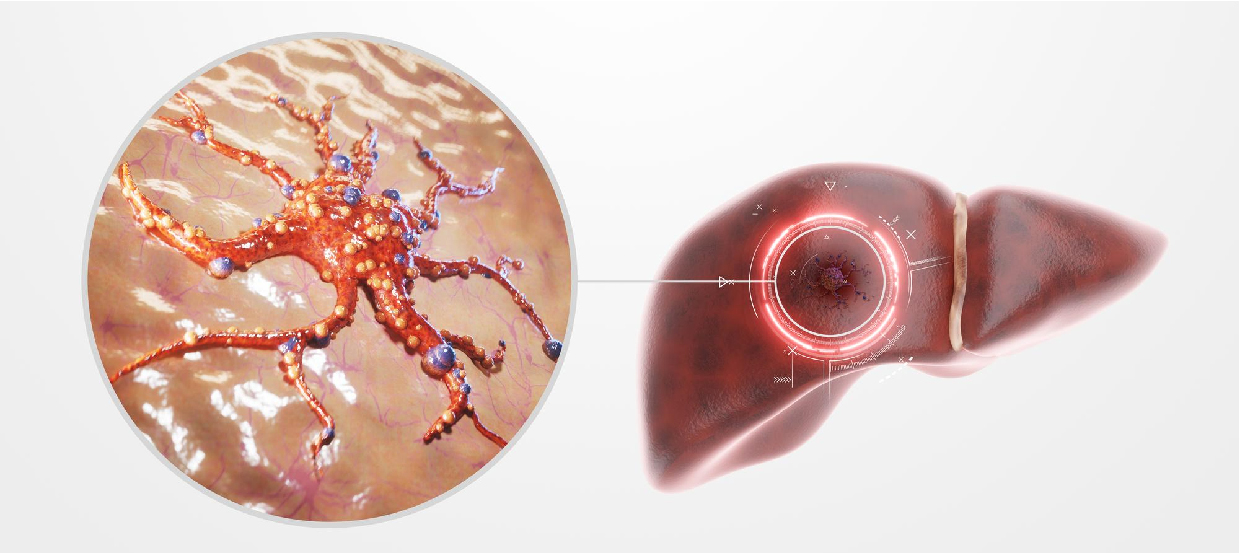 How much does Liver Cancer Treatment Cost in Pune?