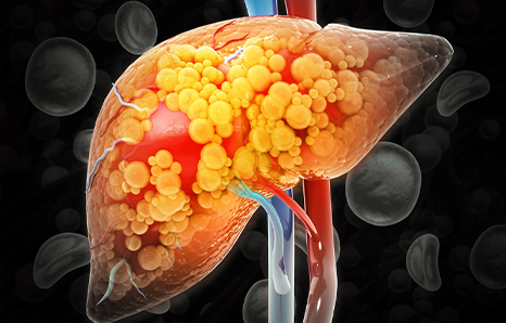 Fatty Liver To Liver Failure: Understanding The Progression & Prevention