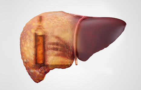 Alcohol & Your Liver: How Much Is Too Much?