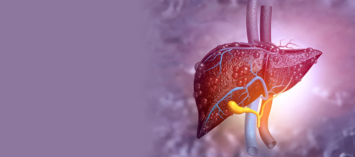 What Causes Fatty Liver and How to Reverse It