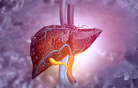 What Causes Fatty Liver and How to Reverse It