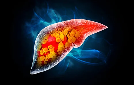 Liver Fibrosis: Stages and Reversal Possibilities