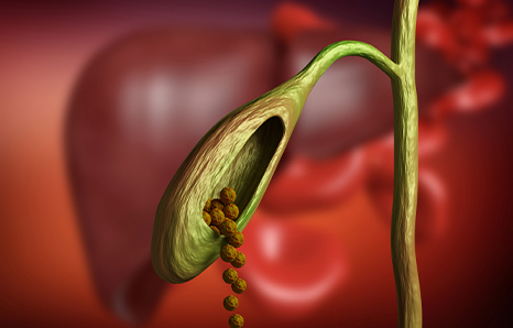 Bile Duct Cancer: Symptoms, Risk Factors, Diagnosis, and Treatment Choices