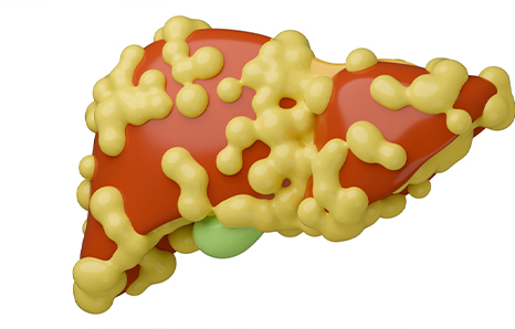 Comprehensive Non-Alcoholic Steatohepatitis Treatment in Lucknow
