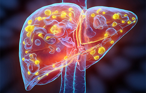 Liver Transplant Rejection: Signs & Prevention Tips