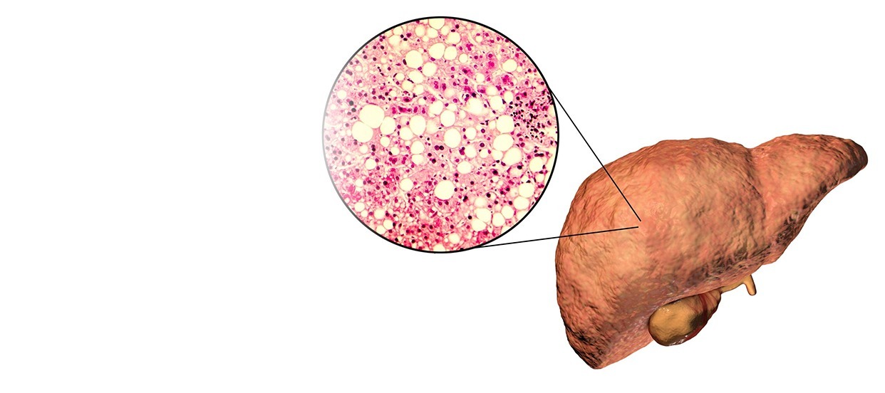 Nonalcoholic Fatty Liver Disease: Causes, Symptoms, and Treatment Options