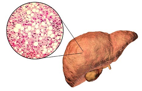 Nonalcoholic Fatty Liver Disease: Causes, Symptoms, and Treatment Options