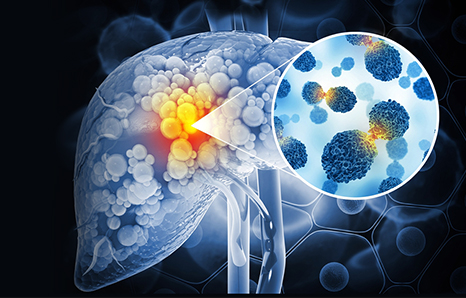 Liver Cancer Treatment in Lucknow: Best Options for Effective Care
