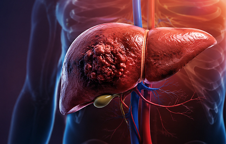 What Really Causes Liver Cancer? Top Risk Factors You Should Know