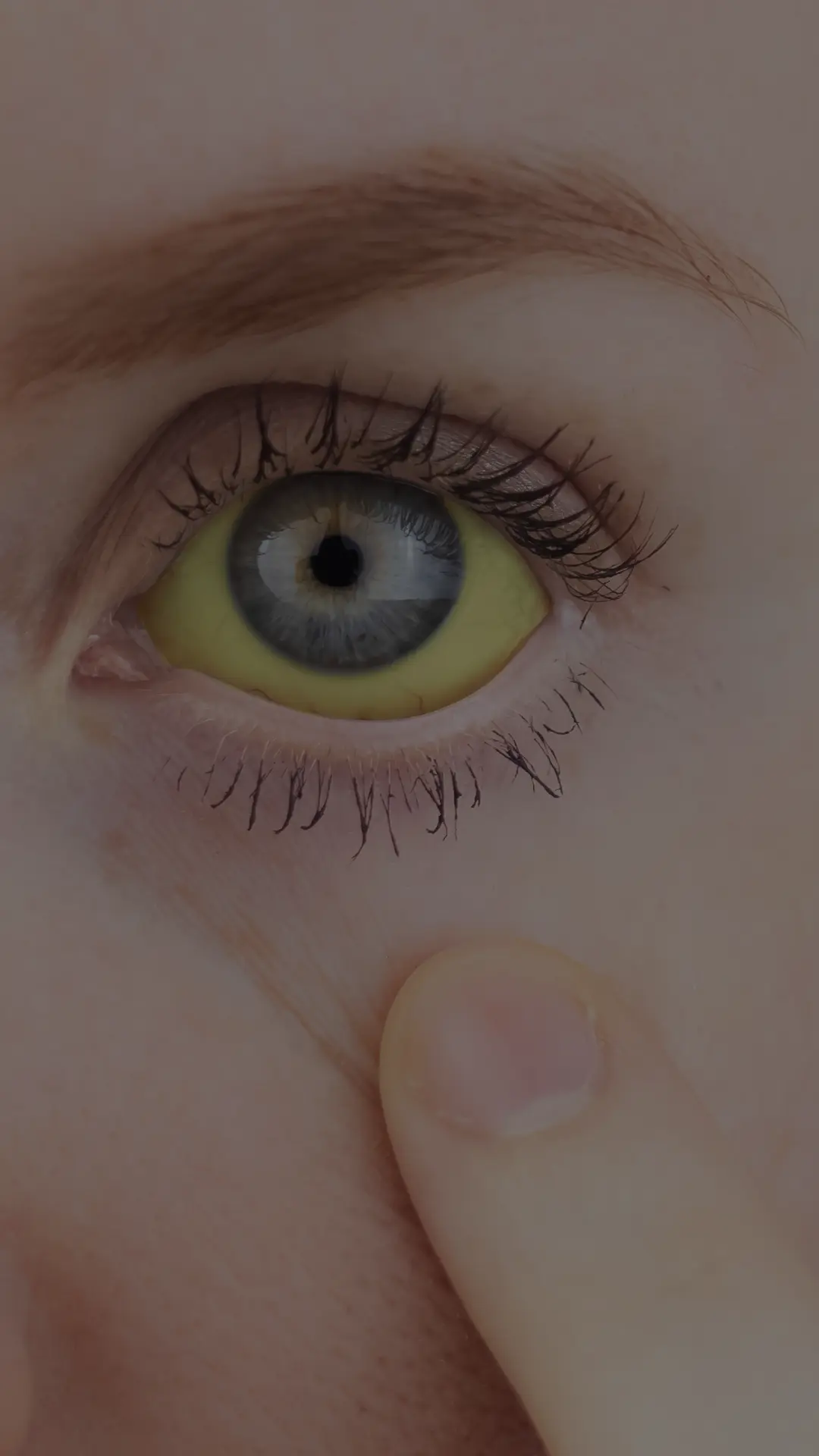 Jaundice